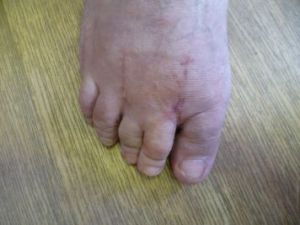 Ятрогенный Hallus valgus. Молоткообразные пальцы. Метатарзалгия.